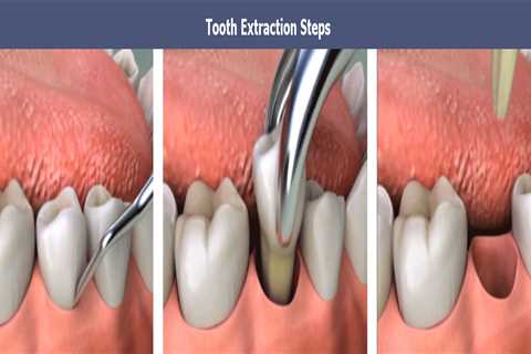 The Buzz on Tooth Extractions