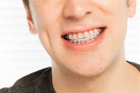 Life With Braces: Tips and Tricks for Managing Discomfort | Smilebliss
