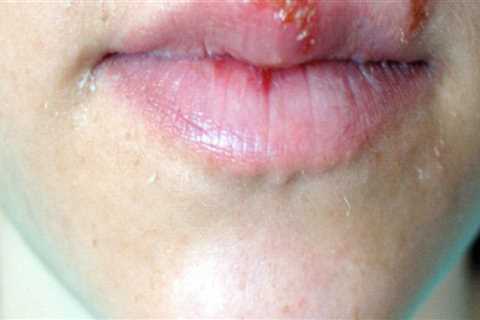 Skin Damage and Herpes: An In-Depth Look at Causes and Environmental Factors