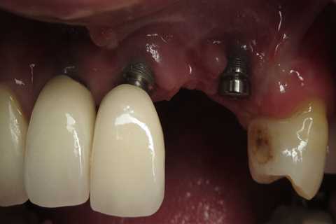 Do dental implants ever have to be removed?