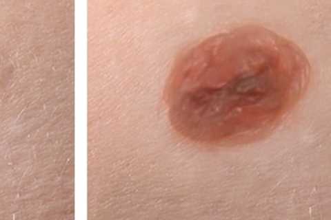 Types of Surgical Mole Removal