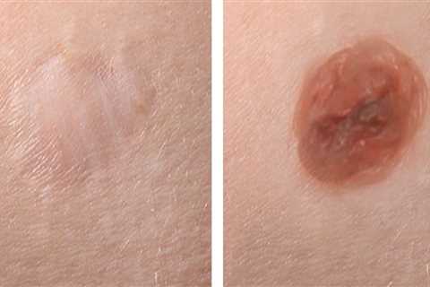 Scarring Risks Associated with Mole Removal