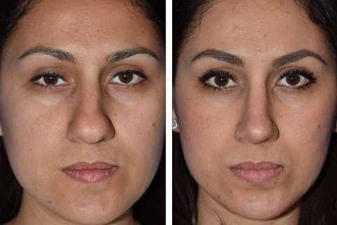 The Seattle Rhinoplasty Center