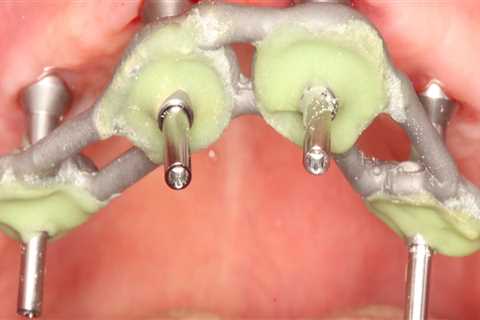 The Benefits and Risks of Intraoral Cameras in Dentistry