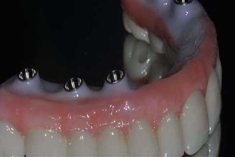 What Materials are Used for Teeth Implants?