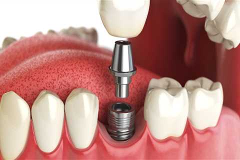 Can I Get a Dental Implant Crown Replacement?