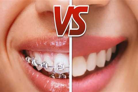 Invisalign vs Braces: Which Orthodontic Appliance is Best for You?