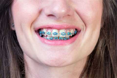 How Braces Can Help Improve Your Bite and Prevent Oral Health Issues