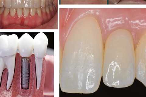 Smile Makeover: A Solution to Missing Teeth