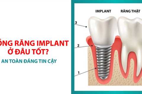 Trồng răng Implant ở đâu tốt nhất? Tiêu chí đánh giá đơn vị nha khoa uy tín  
