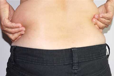 Who can perform laser liposuction?