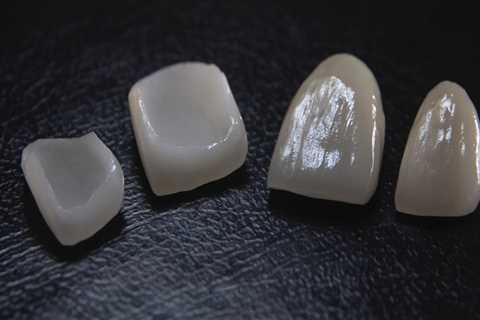How General Dentistry Can Help Maintain Your Porcelain Veneers In Georgetown