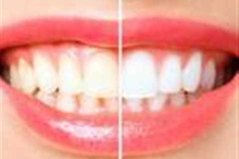 Teeth whitening patients