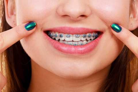 How Braces Transform Your Smile: Correcting Overcrowded, Crooked Teeth, and Gaps