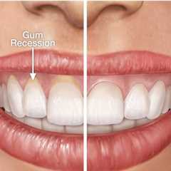How To Fix Receding Gums Without Surgery
