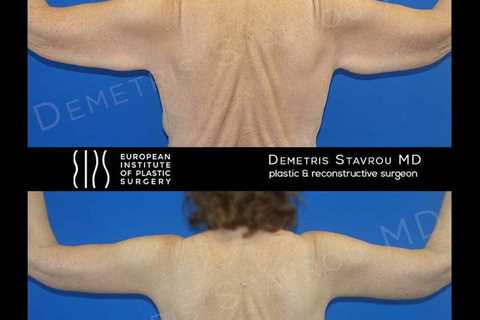 Standard post published to Dr. Demetris Stavrou - European Institute of Plastic Surgery - Nicosia..