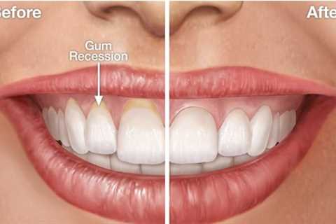 How To Fix Receding Gums Without Surgery