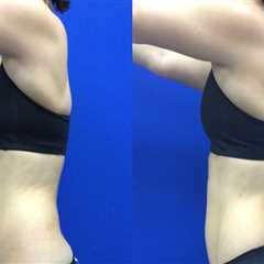 How long after laser liposuction do you see results?