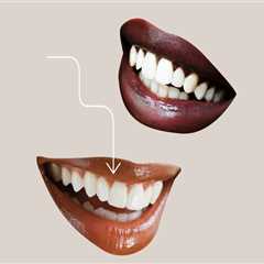 Cosmetic Treatments In Dripping Springs: A Guide To Understanding Dental Veneers And Their Uses