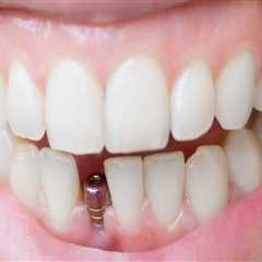 How real do dental implants look?