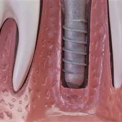 Why dental implants expensive?