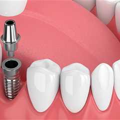 All You Need To Know About Dental Veneers And Dental Implants In Allen, TX