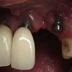 Do dental implants ever have to be removed?