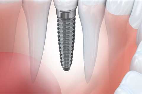 Choosing The Right Dentist For Dental Implants In Rockville, MD