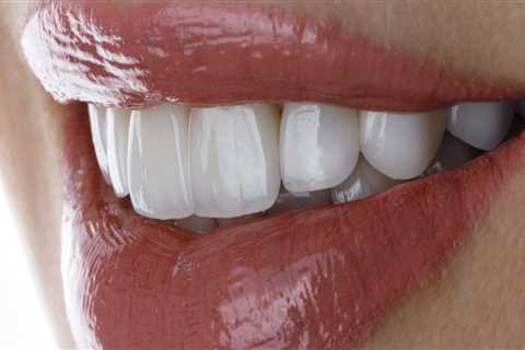 Do veneers come off easily?