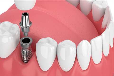 How long does a dental implant last?