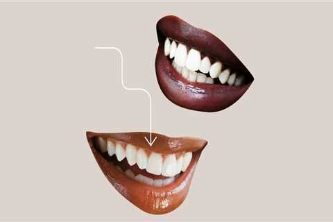 Do you get veneers on every tooth?