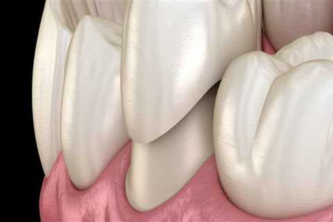 Different Types of Dental Crowns: A Comprehensive Guide