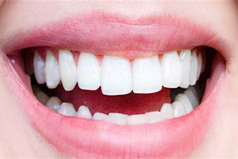 How A Dentist In Kansas City Can Help You Achieve Your Perfect Smile Makeover?