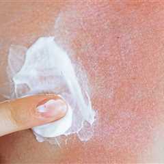 Impact of Sunburn on Skin Cancer Risk: A Troubling Reality