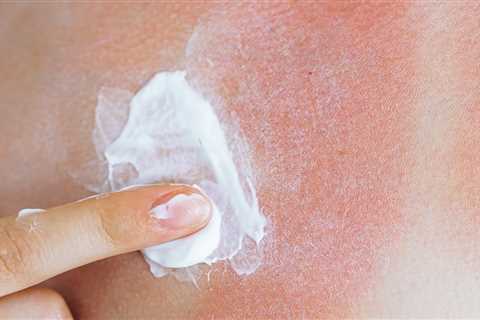 Impact of Sunburn on Skin Cancer Risk: A Troubling Reality