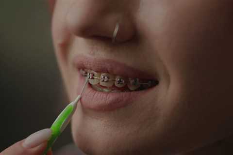 Braces for Athletes: How to Protect Your Smile During Sports