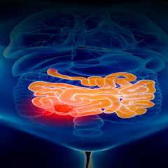 Unveiling the Underlying Factors Driving the Rise in Early-Onset Bowel Cancer