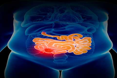 Unveiling the Underlying Factors Driving the Rise in Early-Onset Bowel Cancer