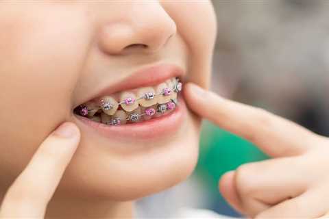 First-Time Guide to Standard Metal Braces for Preteens and Tweens