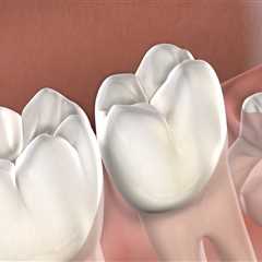 Beyond The Pull: Understanding Wisdom Teeth Extraction In San Diego, CA
