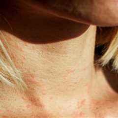 Revolutionary Eczema Relief: Dermatologists Unveil Game-Changing Tips