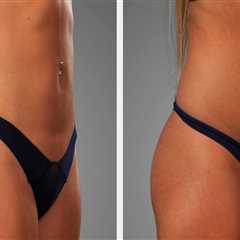 Sculpt And Soothe: How Liposuction In Scottsdale Can Help Relieve Neck Pain