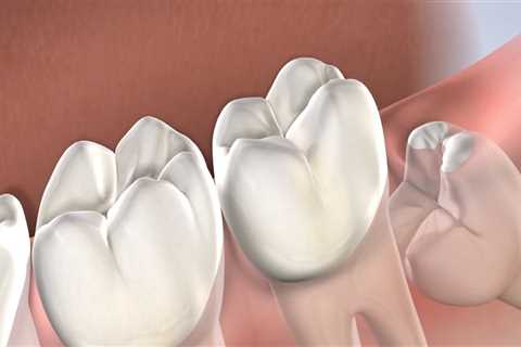 Beyond The Pull: Understanding Wisdom Teeth Extraction In San Diego, CA