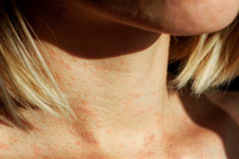 Revolutionary Eczema Relief: Dermatologists Unveil Game-Changing Tips