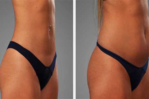 Sculpt And Soothe: How Liposuction In Scottsdale Can Help Relieve Neck Pain