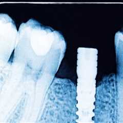 How Dental X-Rays Influence Treatment Planning for Implants and Orthodontics