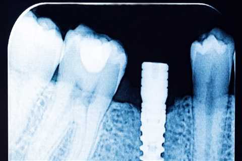 How Dental X-Rays Influence Treatment Planning for Implants and Orthodontics