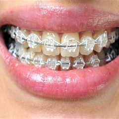 Transform Your Smile with LightForce Braces in Mill Creek