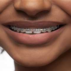 Top 5 Tips for Making Traditional Braces More Comfortable