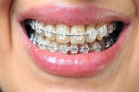 Transform Your Smile with LightForce Braces in Mill Creek